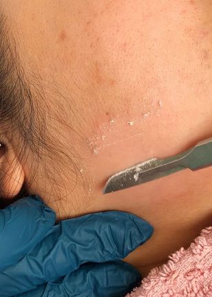 Hoja de dermaplaning deslizándose sobre la piel del rostro