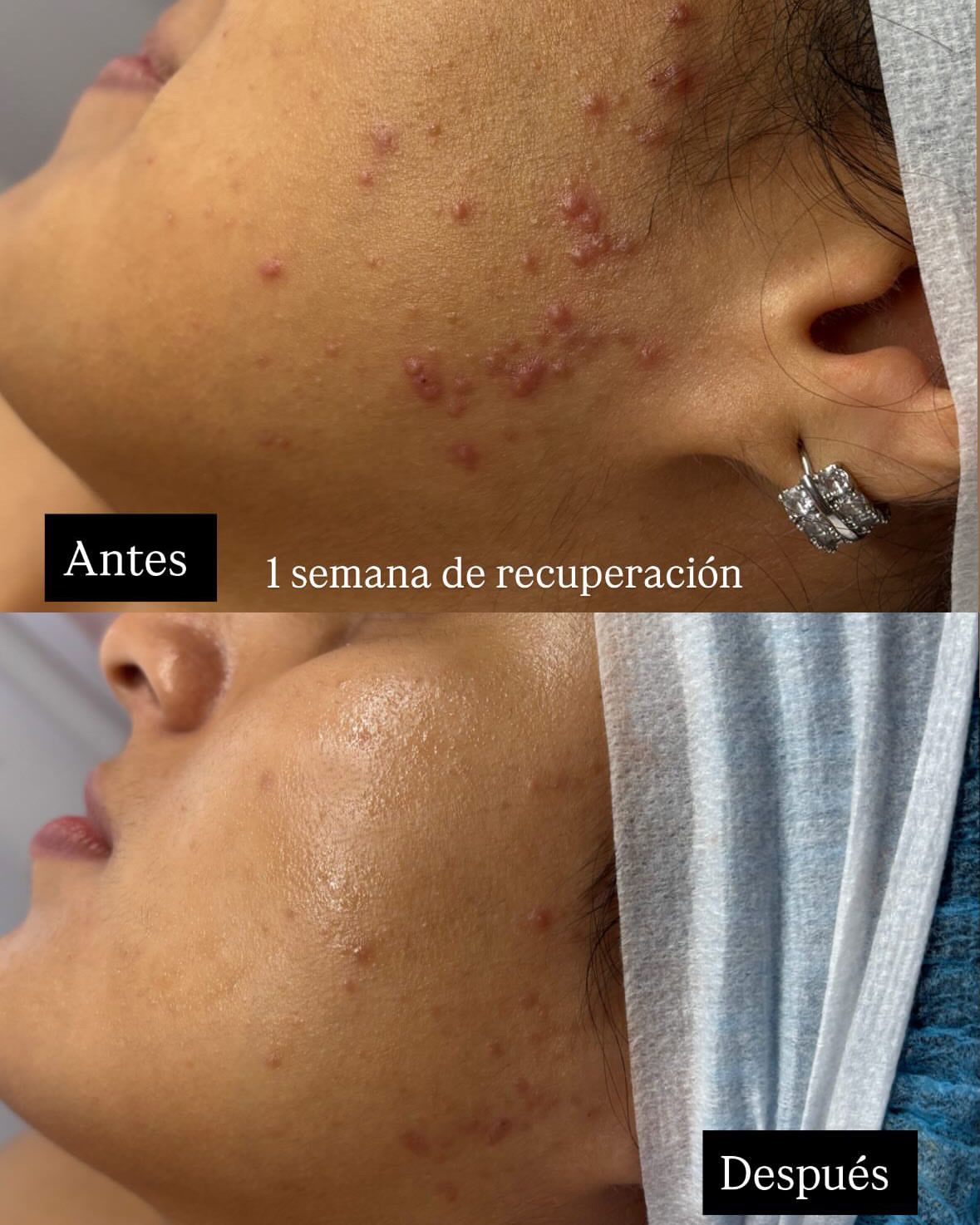 Antes y después de Acne Off en una clienta: arriba la mejilla con granitos inflamados, abajo la piel más calmada tras una semana de recuperación